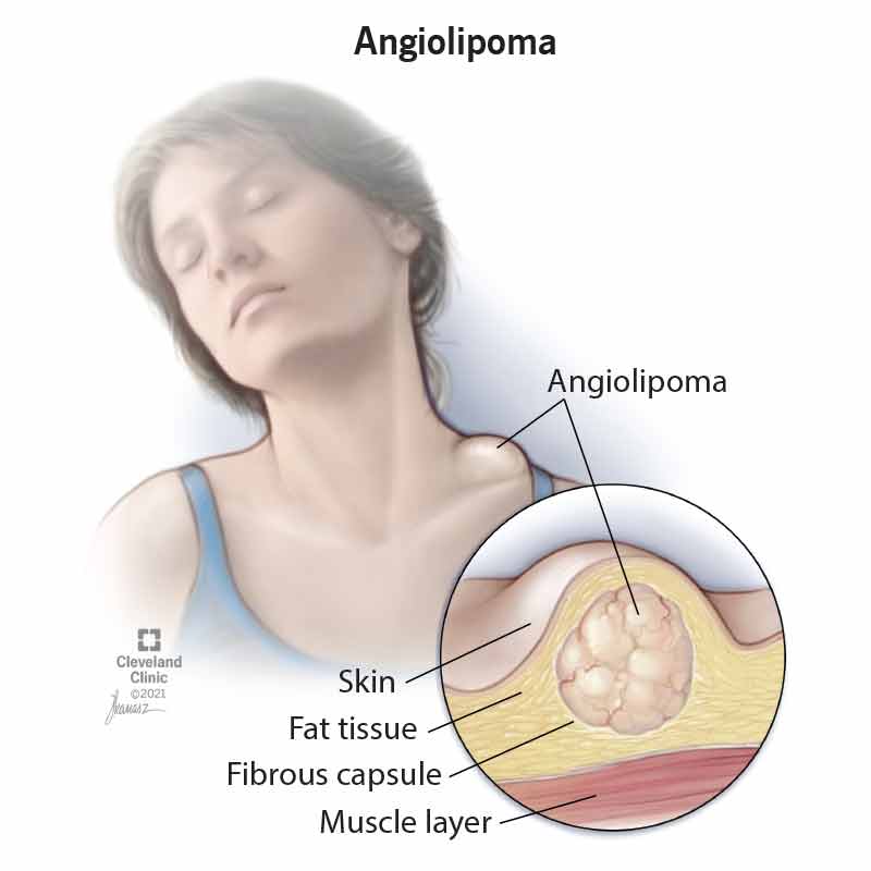 Angiolipoma Symptoms Causes And Treatment   21958 Angiolipoma