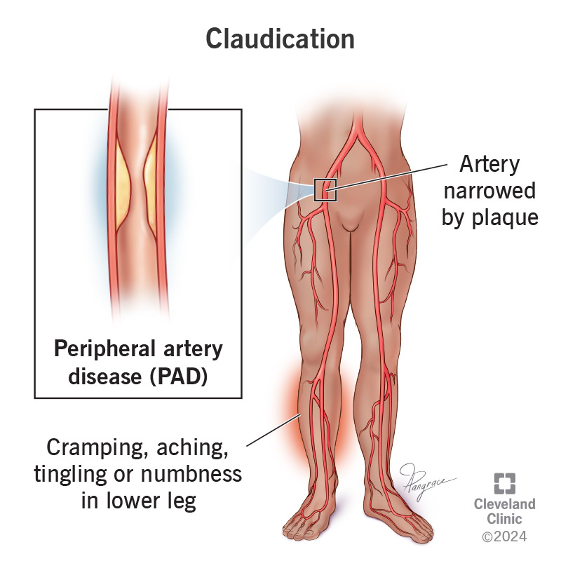 Narrow arteries make it hard for blood to flow, leading to claudication (muscle pain) in your legs