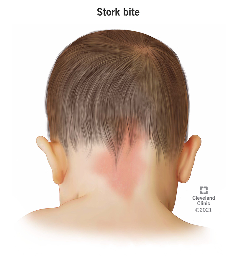A stork bite is a pink, red or purple birthmark (patch of skin) on the back of your head or neck.