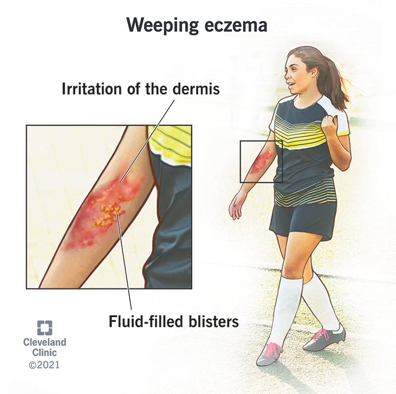 Weeping Eczema