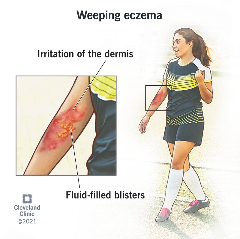 Weeping Eczema Symptoms Causes Treatment And Care 0884