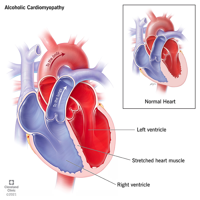 Heart muscle stretching, thinning the walls between heart chambers, that happens because of alcoholic cardiomyopathy.