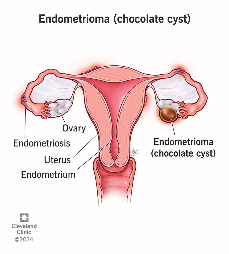 Female reproductive system showing an endometrioma (chocolate cyst) on an ovary