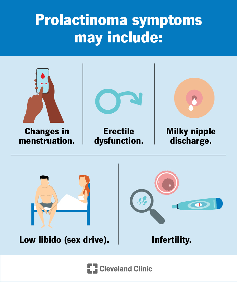 Symptoms of prolactinoma may include milky nipple discharge, low sex drive, infertility, erectile dysfunction and more