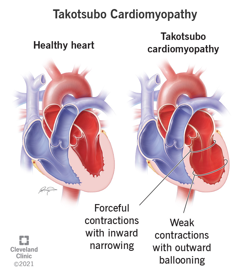 Takotsubo Cardiomyopathy Causes Symptoms And Treatment
