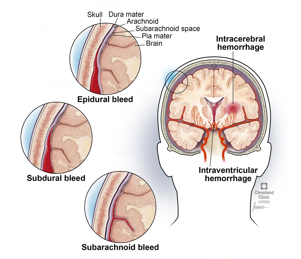 An epidural hematoma is a brain bleed between your skull and the membrane that covers your brain.