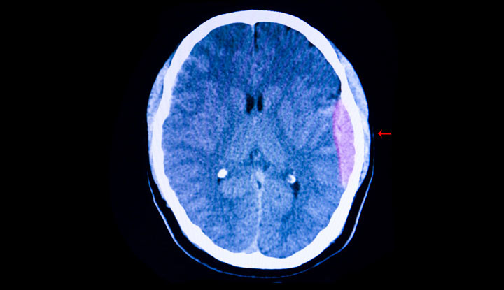 acute epidural hematoma