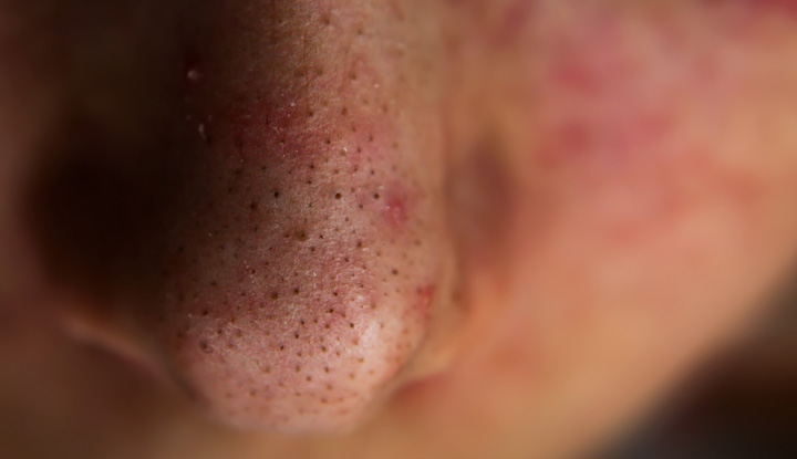 Blackheads on a nose