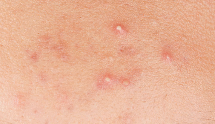 Whiteheads and mild scarring on the surrounding skin