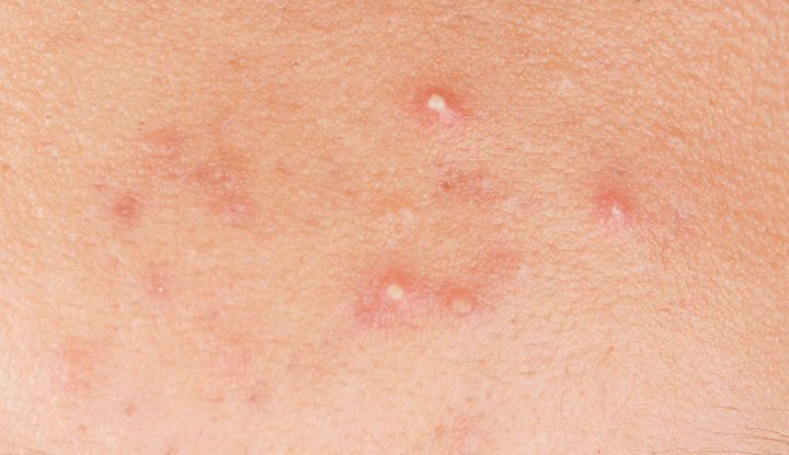 white acne scars on chest