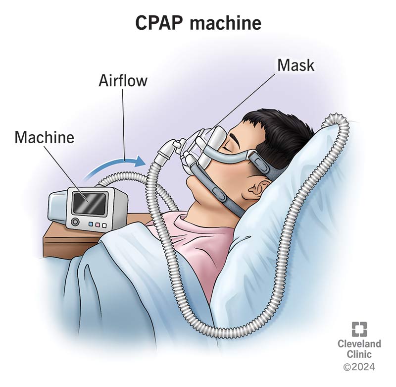 How a CPAP mask works, with person sleeping in bed with mask covering mouth and nose, connected to the machine