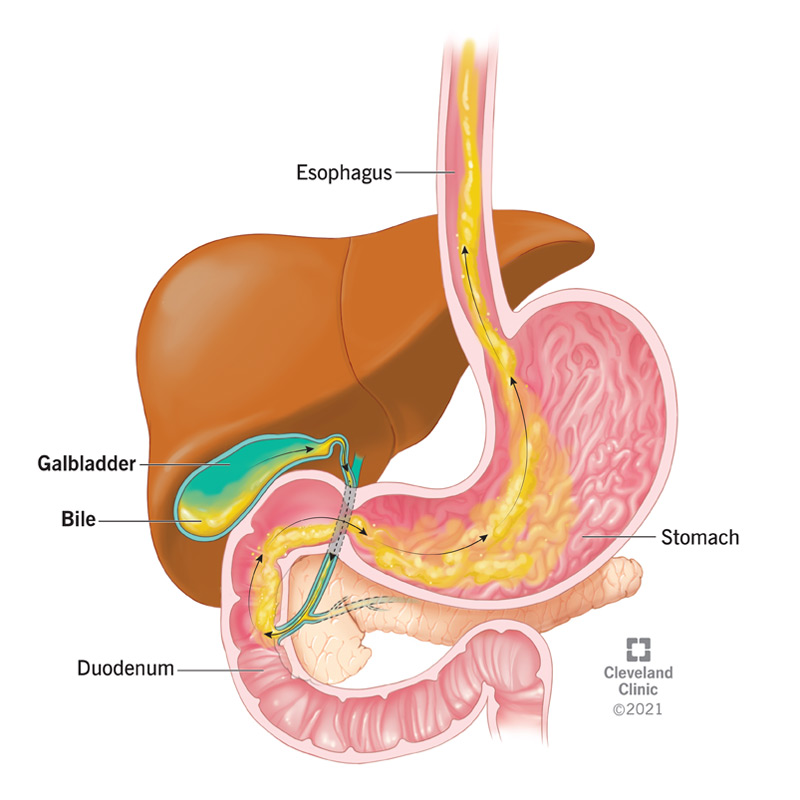 Excess Bile Meaning In Urdu