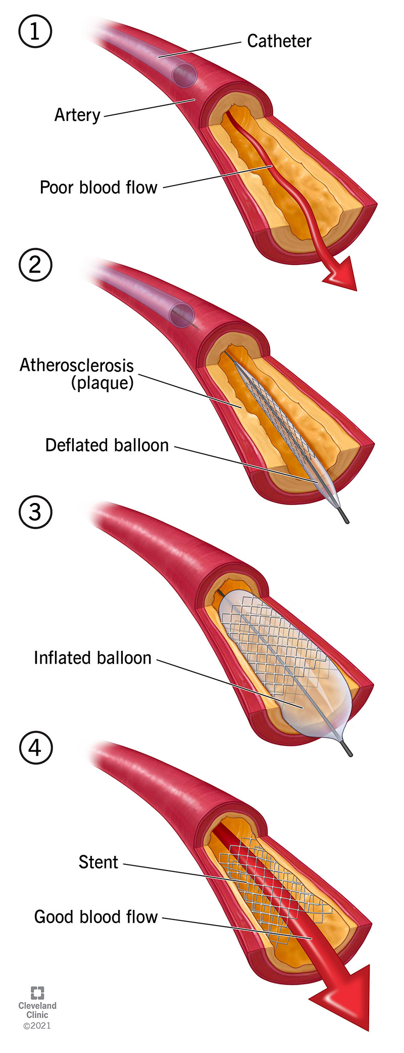 A balloon forces plaque against your artery wall.