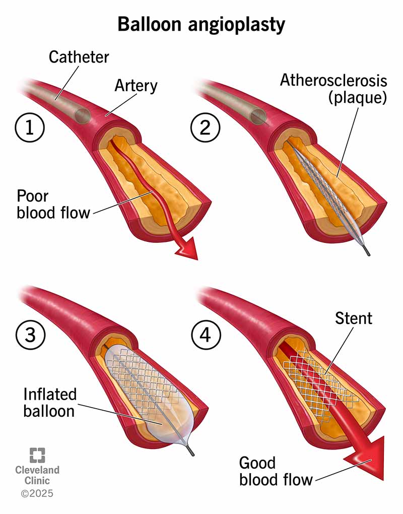 A narrowed artery with plaque has poor blood flow. A balloon moves plaque to the sides, and a stent keeps the artery open