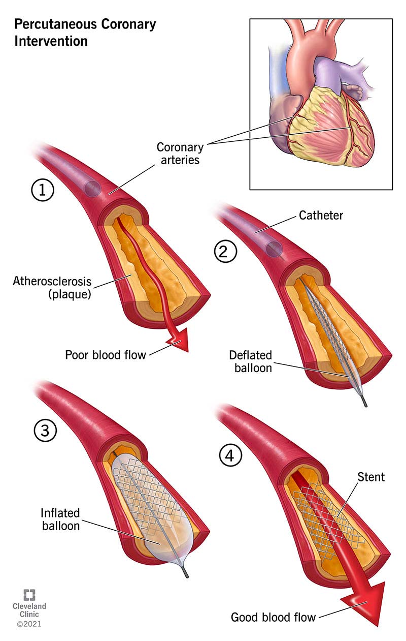 A step-by-step illustration of percutaneous coronary intervention (PCI).