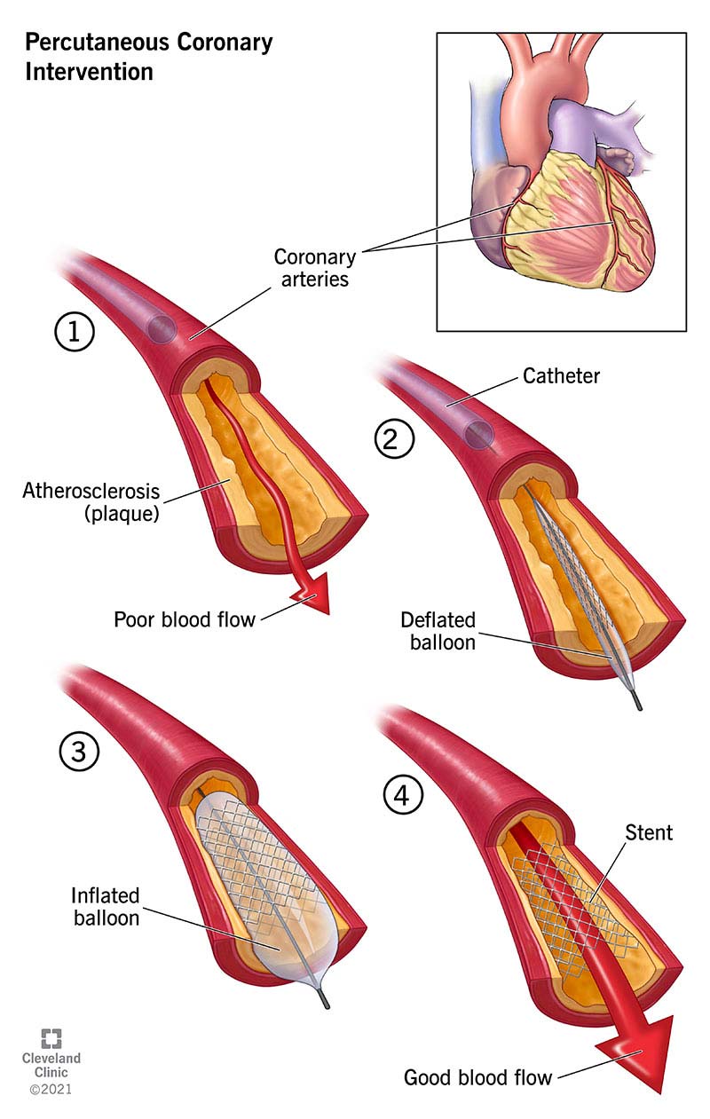 ArogyaJivan Medical Tourism for Cardiology