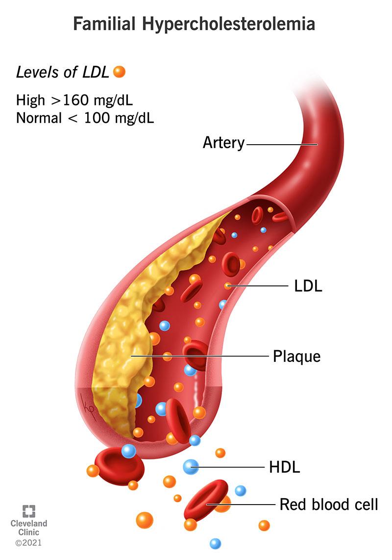Illustration of plaque buildup in arteries from familial hypercholesterolemia.