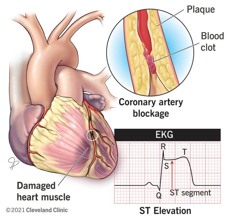 myocardium location