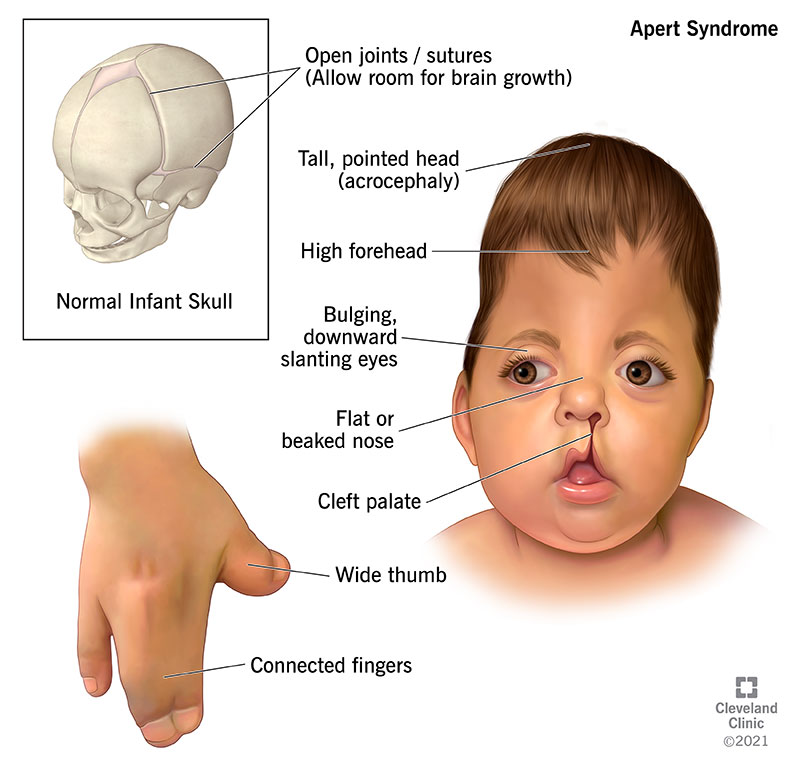 The effects of Apert Syndrome on a child.