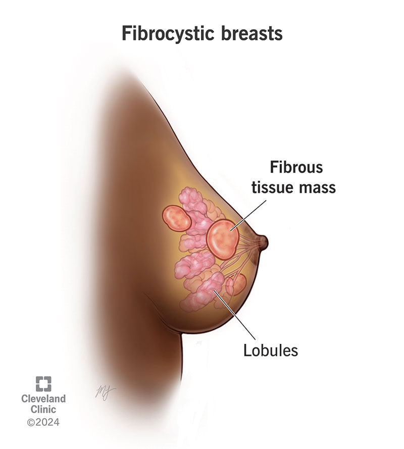 Fibrocystic breast with fibrous tissue masses