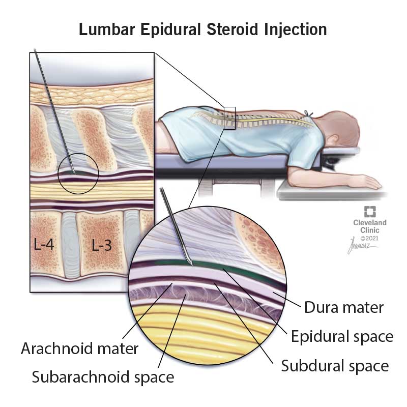 Lumbar Epidural Steroid Injection with Fluoroscopy