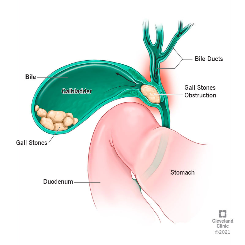 Common bile duct deals stone