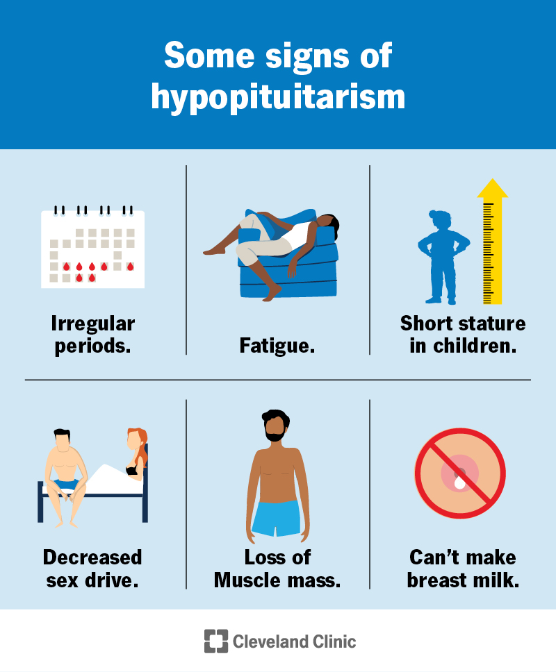 Common symptoms of hypopituitarism are fatigue, loss of muscle mass and loss of libido