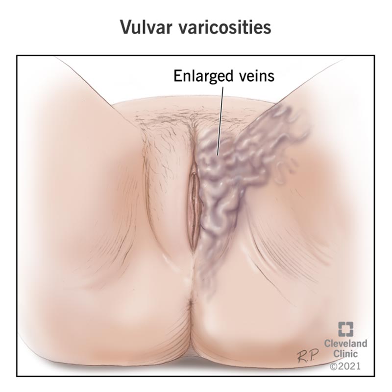 Varicose veins on a vulva.