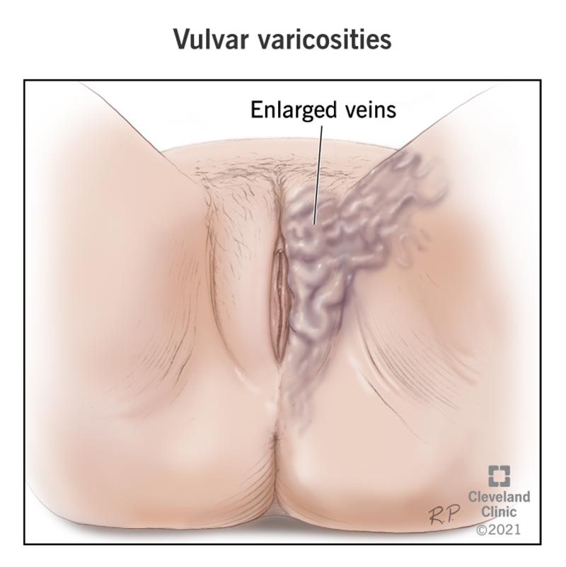 Vulvar Varicosities: Causes, Symptoms, Diagnosis & Treatment