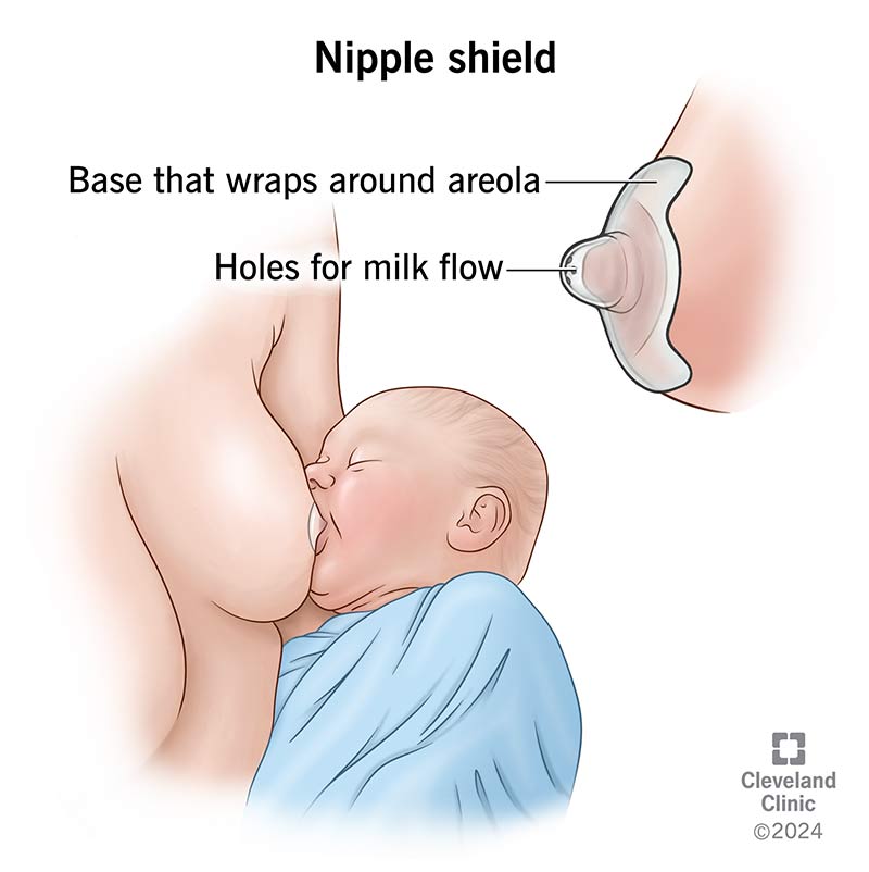 A nipple shield placed over a person’s nipple with a baby latching on to nurse