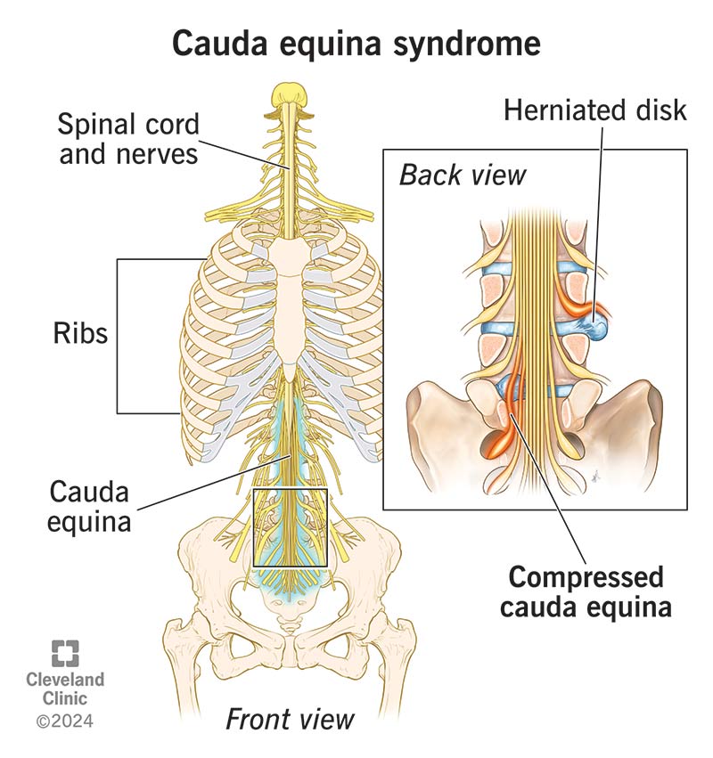 Cauda equina nerves, with cauda equina syndrome with herniated disk and nerve compression