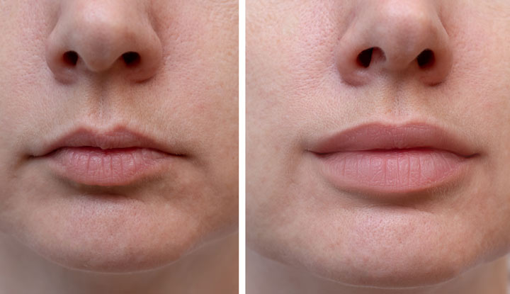 Before and after lip fillers