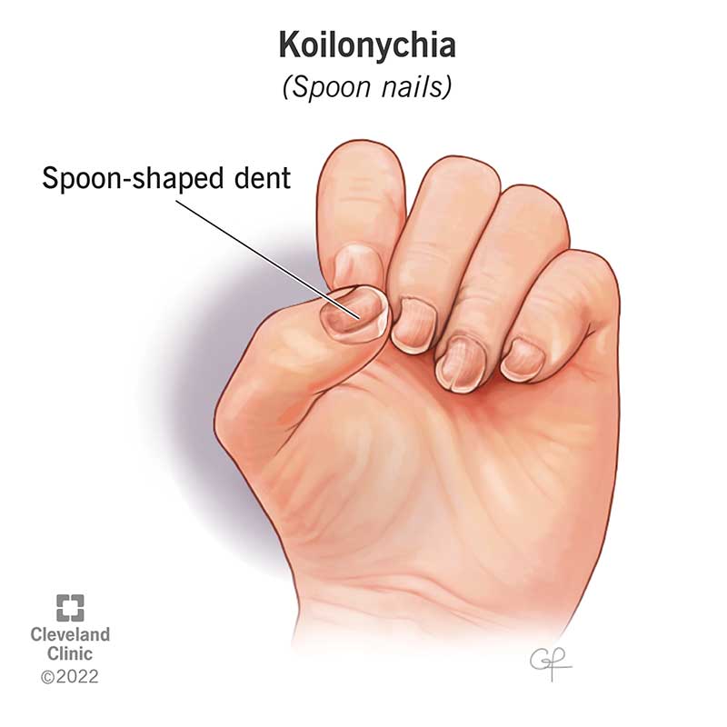 Anemia Toenails