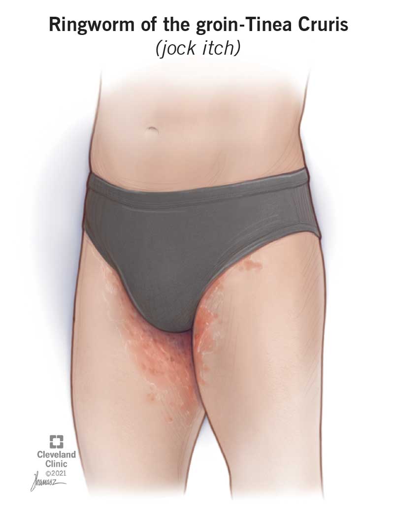 illustration of jock itch fungal infection