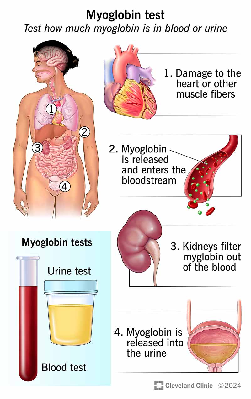 Myoglobin test to check for signs of muscle damage