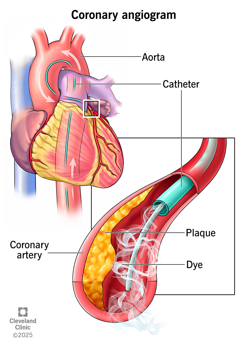 Coronary angiogram test to identify blood flow restrictions going to the heart.