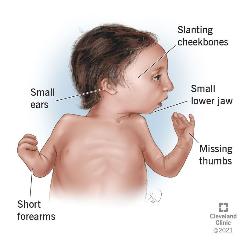 Some of the signs of Nagar Syndrome in a newborn.