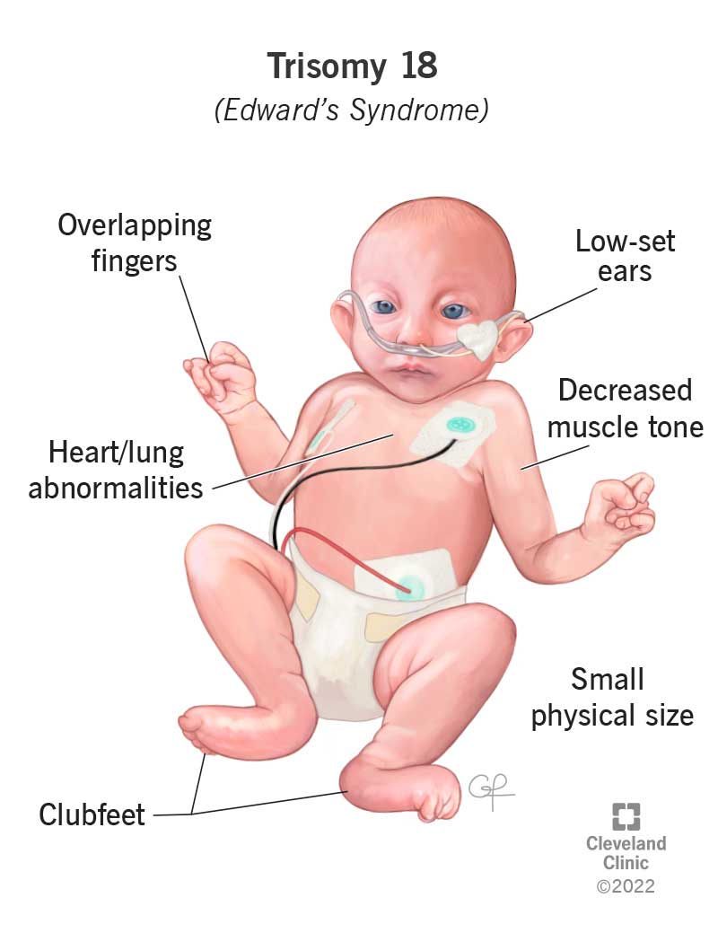 heart defect trisomy