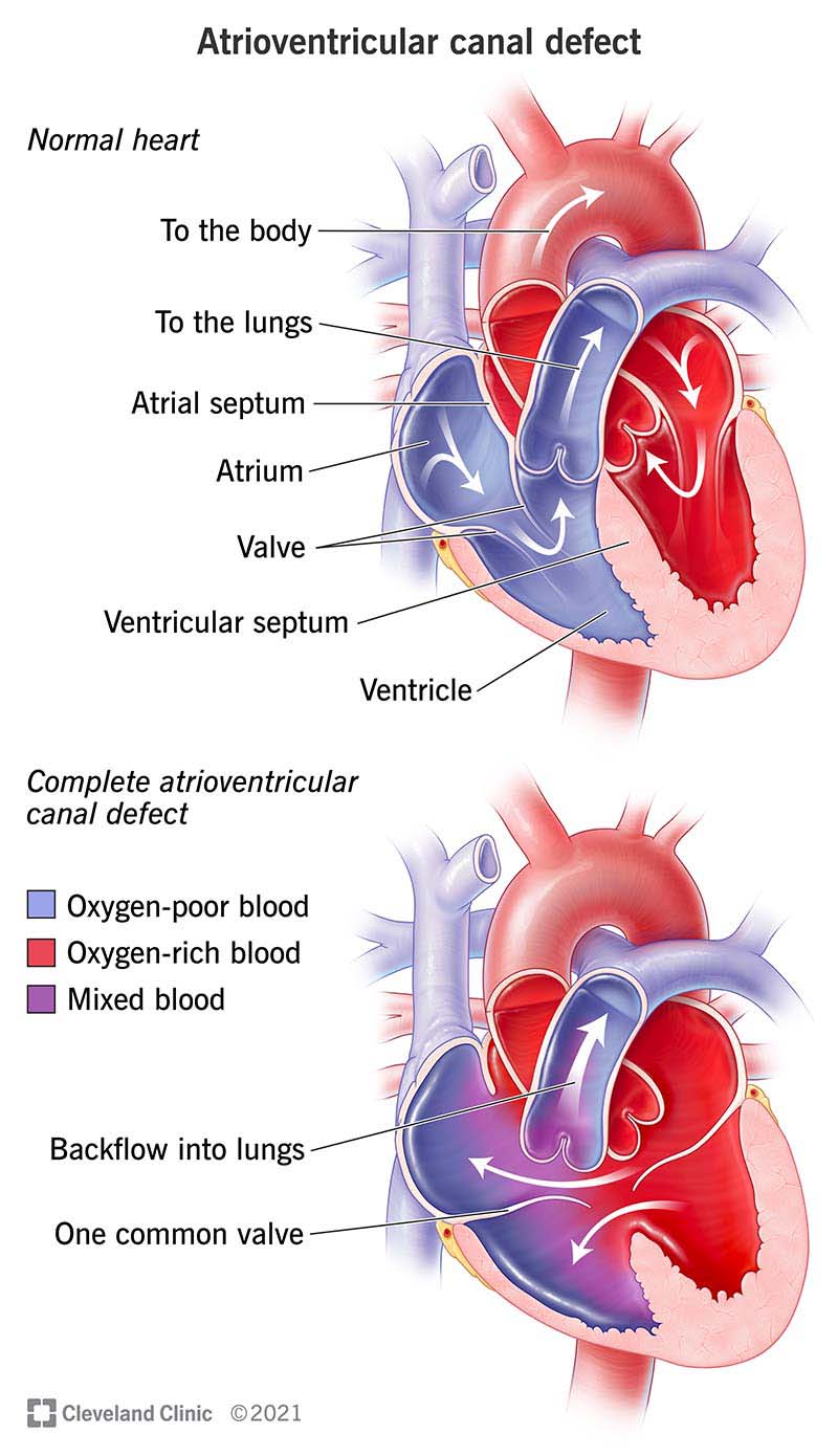 Diagram illustrating how a complete atrioventricular canal defect effects blood flow.