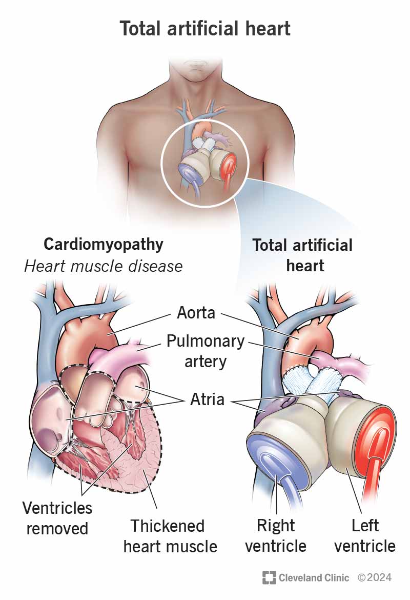 An artificial heart replaces both of your ventricles with mechanical pumps that move your blood