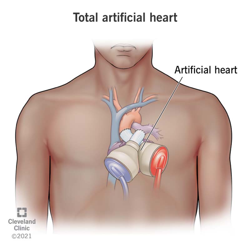Total artificial heart device.