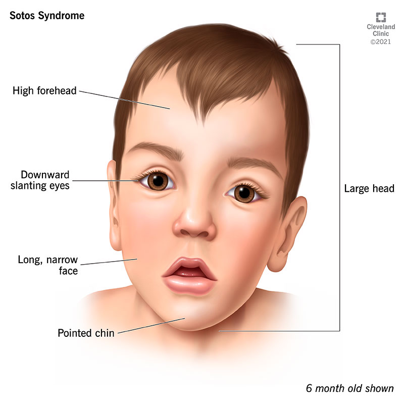 Physical characteristics such as a large head with a long, narrow face, downward slanting eyes and a pointed chin.