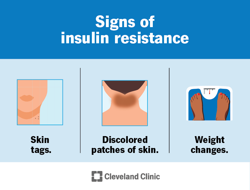 Signs of insulin resistance may include skin tags, discolored patches of skin or changes to your weight.