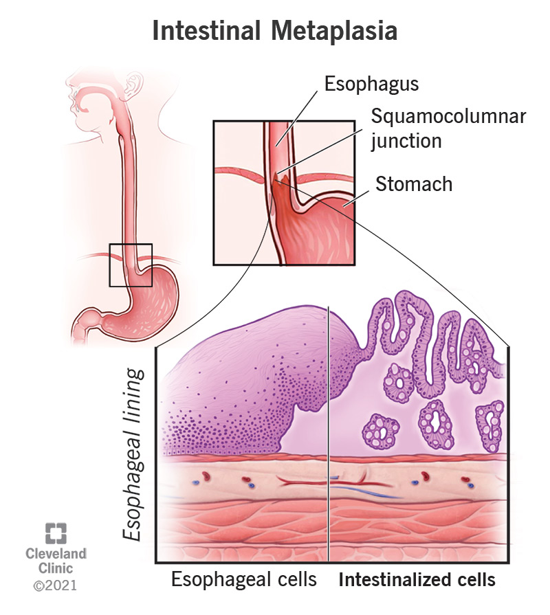 Intestinal metaplasia is when the cells lining your stomach or esophagus are replaced by potentially precancerous cells.