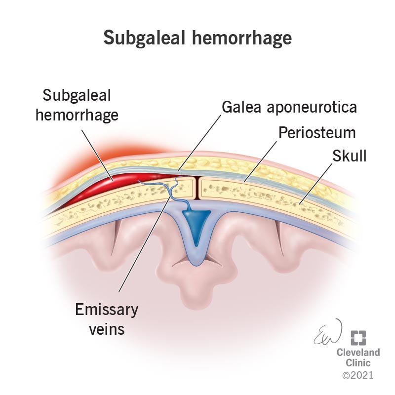A subgaleal hemorrhage occurs when blood collects between tissues on a newborn's skull.