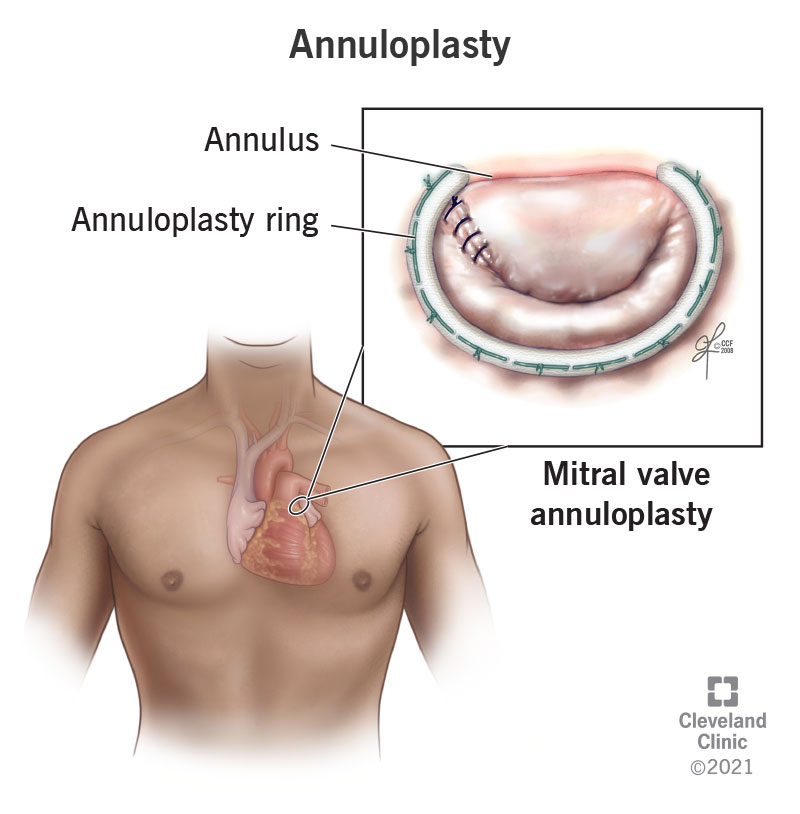 recovery after aortic valve surgery