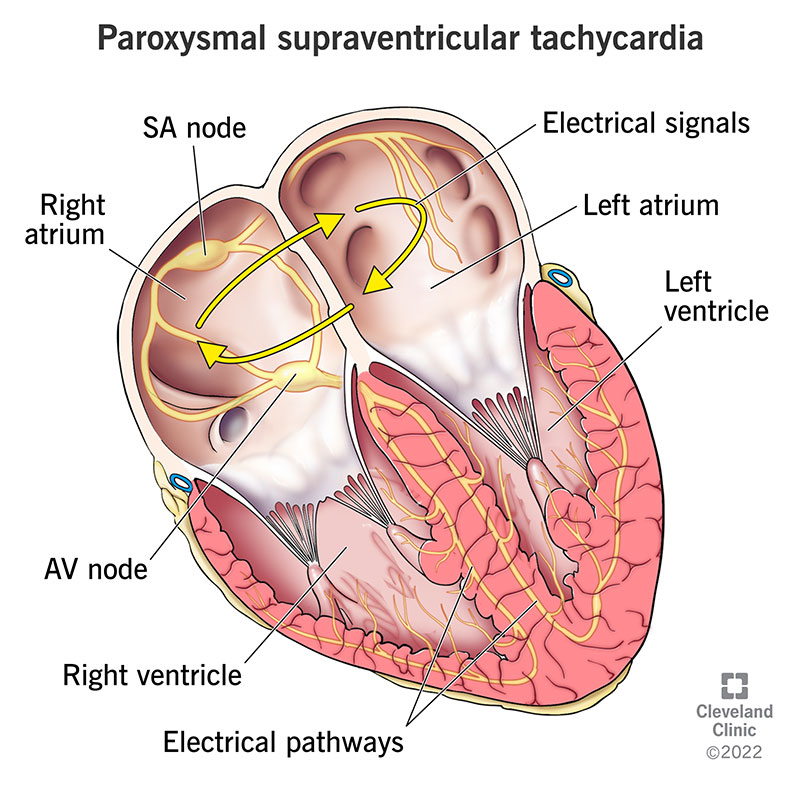  In paroxysmal supraventricular tachycardia, the electrical signals in the atria travel in a circular pattern.  Caption: In paroxysmal supraventricular tachycardia (PSVT), electrical signals travel in a circular pattern that cause the atria to contract quickly and making your heart beat faster than it should.