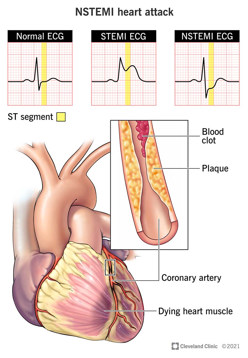 An NSTEMI happens when a part of your heart is not getting enough oxygen.