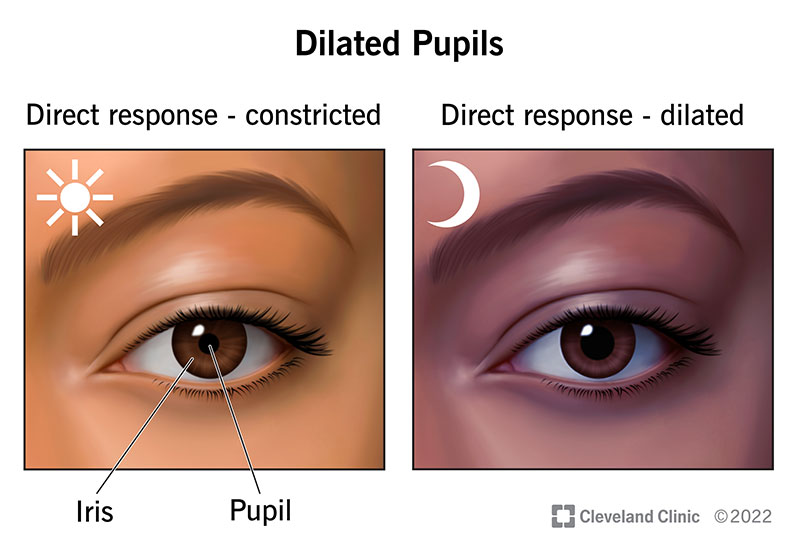Illustration of constricted vs. dilated pupils