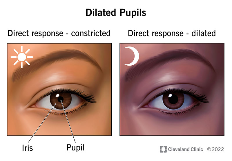 abnormal-pupils